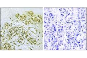 Immunohistochemistry analysis of paraffin-embedded human breast carcinoma, using IkappaB-alpha (Phospho-Tyr42) Antibody. (NFKBIA 抗体  (pTyr42))