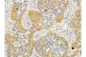 SDF4 Mouse Monoclonal Antibody at 1/100 staining human lung cancer by IHC-P. (SDF4 抗体)