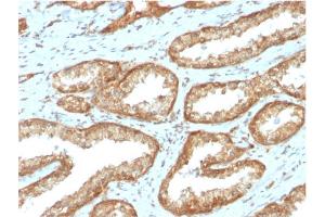 Formalin-fixed, paraffin-embedded human Prostate Carcinoma stained with YBX1 Mouse Monoclonal Antibody (YBX1/2430) (YBX1 抗体)