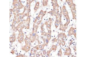 Immunohistochemistry of paraffin-embedded Human liver cancer using ATP5A1 Polyclonal Antibody at dilution of 1:100 (40x lens). (ATP5A1 抗体)