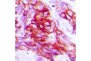 Immunohistochemical analysis of Syntaxin 1A (pS14) staining in human prostate cancer formalin fixed paraffin embedded tissue section. (STX1A 抗体  (N-Term, pSer14))
