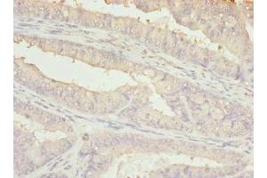 Immunohistochemistry of paraffin-embedded human endometrial cancer using ABIN7145239 at dilution of 1:100 (BBS2 抗体  (AA 1-96))