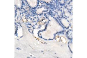 Immunohistochemistry of paraffin-embedded human thyroid cancer using eNOS Rabbit mAb (ABIN7268920) at dilution of 1:200 (40x lens). (ENOS 抗体)