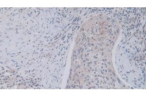 Detection of JAM2 in Human Lung cancer Tissue using Polyclonal Antibody to Junctional Adhesion Molecule 2 (JAM2) (JAM2 抗体  (AA 74-250))