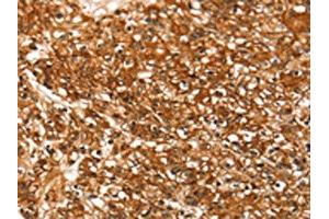 The image on the left is immunohistochemistry of paraffin-embedded Human prostate cancer tissue using ABIN7192401(SLC16A3 Antibody) at dilution 1/30, on the right is treated with synthetic peptide. (SLC16A3 抗体)