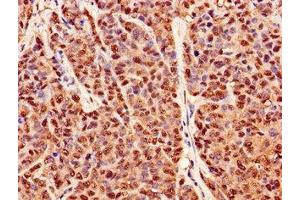 Immunohistochemistry of paraffin-embedded human ovarian cancer using ABIN7162945 at dilution of 1:100 (Peroxiredoxin 6 抗体  (AA 87-224))