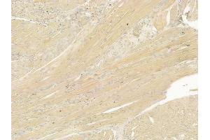ABIN6265947 and ABIN6277546 at 1/100 staining human tongue carcinoma by IHC-P.