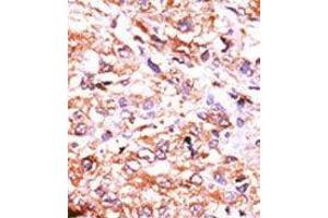 Formalin-fixed and paraffin-embedded human cancer tissue reacted with the primary antibody, which was peroxidase-conjugated to the secondary antibody, followed by AEC staining. (GUCY1A2 抗体  (N-Term))