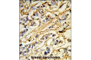 Formalin-fixed and paraffin-embedded human breast carcinoma reacted with CHMP4B Antibody (N-term), which was peroxidase-conjugated to the secondary antibody, followed by DAB staining. (CHMP4B 抗体  (N-Term))