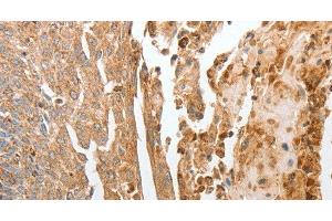 Immunohistochemistry of paraffin-embedded Human cervical cancer using NPY1R Polyclonal Antibody at dilution of 1:30 (NPY1R 抗体)