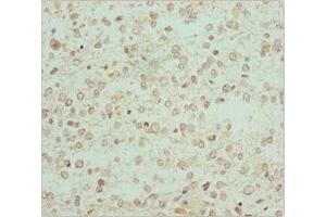 Immunohistochemistry of paraffin-embedded human glioma using ABIN7167743 at dilution of 1:100 (RCN2 抗体  (AA 23-180))