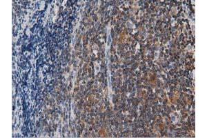 Immunohistochemical staining of paraffin-embedded Human lymphoma tissue using anti-ARHGAP25 mouse monoclonal antibody. (ARHGAP25 抗体)