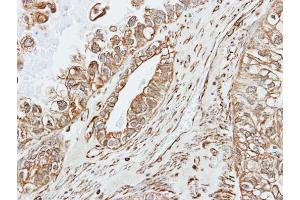 IHC-P Image Immunohistochemical analysis of paraffin-embedded human ovarian cancer, using alpha amylase 2A(pancreatic), antibody at 1:500 dilution. (AMY2A 抗体)
