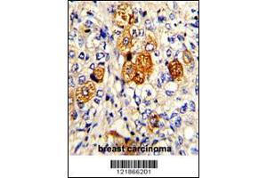 Formalin-fixed and paraffin-embedded human breast carcinoma with C5 Antibody (N-term), which was peroxidase-conjugated to the secondary antibody, followed by DAB staining. (C5 抗体  (N-Term))
