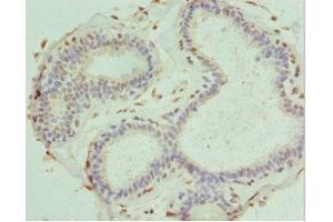 Immunohistochemistry of paraffin-embedded human breast cancer using ABIN7166867 at dilution of 1:100 (PDXK 抗体  (AA 1-312))