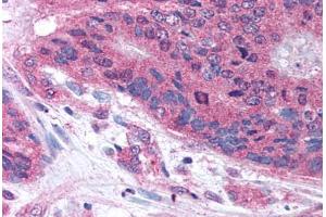 Human Colon Carcinoma (formalin-fixed, paraffin-embedded) stained with PLA2G3 antibody ABIN213634 at 10 ug/ml followed by biotinylated goat anti-rabbit IgG secondary antibody ABIN481713, alkaline phosphatase-streptavidin and chromogen. (PLA2G3 抗体  (Internal Region))