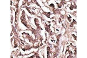 IHC analysis of FFPE human breast carcinoma tissue stained with the APG7 antibody (ATG7 抗体  (AA 284-313))