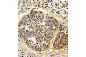 Formalin-fixed and paraffin-embedded human lung carcinoma reacted with HMGCS1 Antibody (C-term), which was peroxidase-conjugated to the secondary antibody, followed by DAB staining. (HMGCS1 抗体  (C-Term))