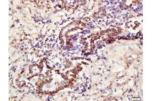 Formalin-fixed and paraffin embedded human lung carcinoma labeled with Rabbit Anti-CD361 Polyclonal Antibody, Unconjugated  at 1:200 followed by conjugation to the secondary antibody and DAB staining (EVI2B 抗体  (AA 151-250))