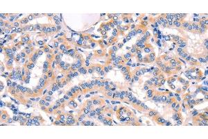 Immunohistochemistry of paraffin-embedded Human thyroid cancer using AMY2A Polyclonal Antibody at dilution of 1:50 (AMY2A 抗体)