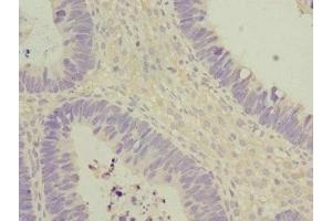 Immunohistochemistry of paraffin-embedded human ovarian cancer using ABIN7172903 at dilution of 1:100