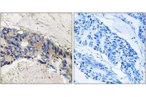 Immunohistochemistry analysis of paraffin-embedded human colon carcinoma tissue, using CA1 Antibody. (CA1 抗体  (AA 41-90))