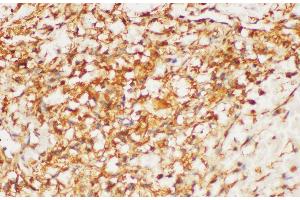 Immunohistochemistry of paraffin-embedded Human kidney cancer using HRAS Polycloanl Antibody at dilution of 1:200 (HRAS 抗体)