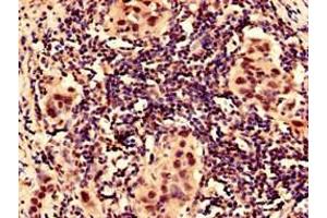 Immunocytochemistry analysis of human bladder cancer using ABIN7156029 at dilution of 1:100
