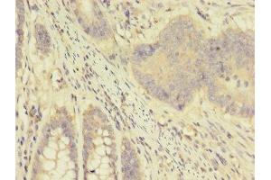 Immunohistochemistry of paraffin-embedded human colon cancer using ABIN7144423 at dilution of 1:100 (Apolipoprotein D 抗体  (AA 21-189))