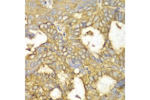 Immunohistochemistry of paraffin-embedded human oophoroma using PRKAR1A antibody at dilution of 1:100 (400x lens).