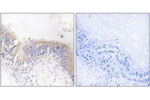 Immunohistochemistry analysis of paraffin-embedded human lung carcinoma tissue, using VGF Antibody. (VGF 抗体  (AA 454-503))