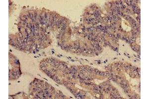Immunohistochemistry of paraffin-embedded human endometrial cancer using ABIN7148409 at dilution of 1:100 (CD35 抗体  (AA 901-1095))