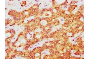 IHC image of ABIN7148547 diluted at 1:400 and staining in paraffin-embedded human liver cancer performed on a Leica BondTM system. (ATOX1 抗体  (AA 1-68))