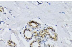 Immunohistochemistry of paraffin-embedded Human breast using BCCIP Polyclonal Antibody at dilution of 1:100 (40x lens). (BCCIP 抗体)