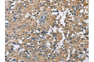 The image on the left is immunohistochemistry of paraffin-embedded Human thyroid cancer tissue using ABIN7128713(CAB39L Antibody) at dilution 1/40, on the right is treated with fusion protein. (CAB39L 抗体)