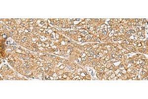 Immunohistochemistry of paraffin-embedded Human liver cancer tissue using C1orf112 Polyclonal Antibody at dilution of 1:110(x200) (C1orf112 抗体)