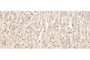 Immunohistochemistry of paraffin-embedded Human ovarian cancer tissue using FYTTD1 Polyclonal Antibody at dilution of 1:30(x200)