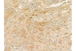 ABIN6257094 and ABIN6275278 at 1/100 staining human lung squamous cell carcinoma by IHC-P.