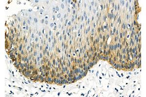 ABIN6259942 and ABIN6277949 at 1/100 staining Human esophageal cancer and adjacent normal tissues by IHC-P.