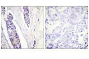 Immunohistochemistry analysis of paraffin-embedded human breast carcinoma tissue, using Tubulin β antibody. (TUBB3 抗体  (C-Term))