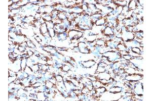 Formalin-fixed, paraffin-embedded human Angiosarcoma stained with Smooth Muscle Actin Monoclonal Antibody (ACTA2/791). (Smooth Muscle Actin 抗体)