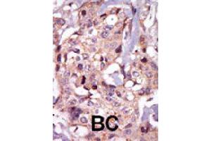 Formalin-fixed and paraffin-embedded human cancer tissue reacted with TEC polyclonal antibody  , which was peroxidase-conjugated to the secondary antibody, followed by AEC staining.