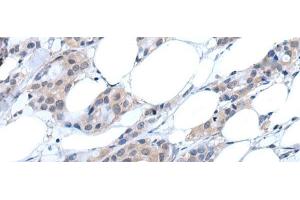Immunohistochemistry of paraffin-embedded Human breast cancer tissue using ANGPTL6 Polyclonal Antibody at dilution of 1:55(x200) (ANGPTL6 抗体)
