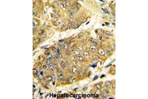 Formalin-fixed and paraffin-embedded human hepatocarcinoma reacted with LTA Antibody (Center), which was peroxidase-conjugated to the secondary antibody, followed by DAB staining. (LTA 抗体  (Middle Region))