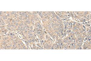 Immunohistochemistry of paraffin-embedded Human liver cancer tissue using C1orf106 Polyclonal Antibody at dilution of 1:80(x200) (C1ORF106 抗体)