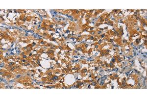 Immunohistochemistry of paraffin-embedded Human thyroid cancer tissue using CRTAM Polyclonal Antibody at dilution of 1:60 (CRTAM 抗体)