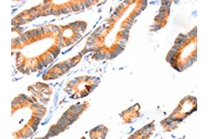 The image on the left is immunohistochemistry of paraffin-embedded Human colon cancer tissue using ABIN7192286(SCNN1A Antibody) at dilution 1/30, on the right is treated with synthetic peptide. (SCNN1A 抗体)