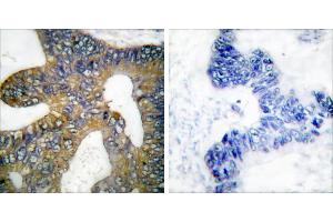 Peptide - +Immunohistochemical analysis of paraffin-embedded human colon carcinoma tissue using HSP105 antibody (#C0231). (HSPH1 抗体)