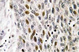 Immunohistochemistry (IHC) analyzes of ATF-1 antibody in paraffin-embedded human lung carcinoma tissue. (AFT1 抗体)