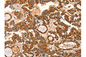 The image on the left is immunohistochemistry of paraffin-embedded Human thyroid cancer tissue using ABIN7129834(IKZF3 Antibody) at dilution 1/60, on the right is treated with fusion protein. (IKZF3 抗体)